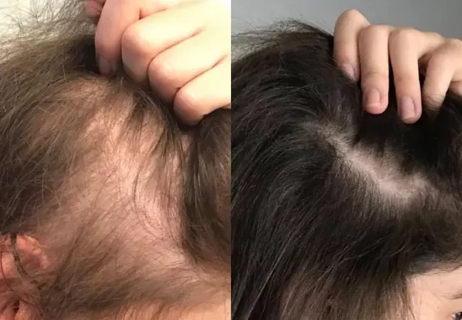 Don't Ignore Hair Loss: Hormonal Changes and Thyroid Problems Could Be the Cause