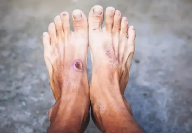 Monsoon and Diabetes: A Complete Guide to Staying Healthy
