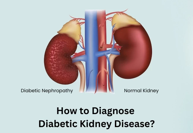 How to Diagnose Diabetic Kidney Disease