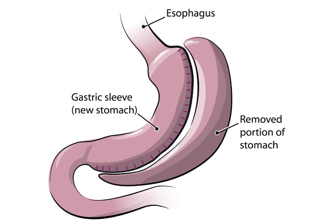 Gastric Sleeve Resection