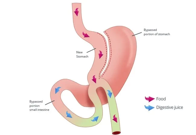 Mini Gastric Bypass